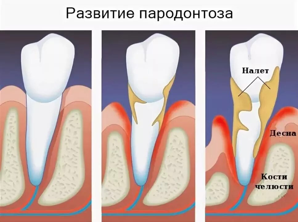 Протетический пародонтит.