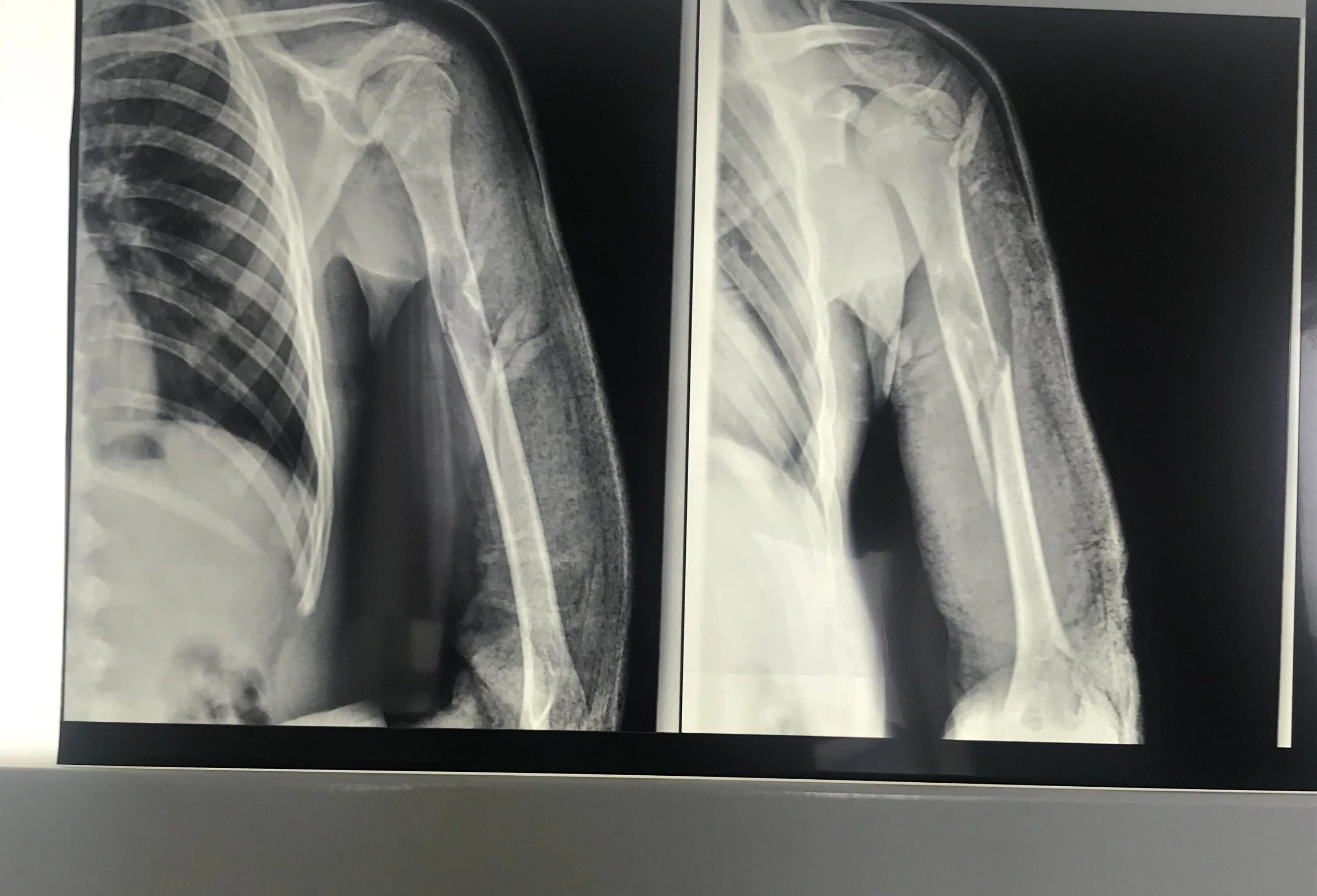 Винтообразный перелом плечевой кости рентген. Винтообразный перелом рентген. Перелом диафиза плечевой кости рентген. Винтообразный перелом плечевой кости.