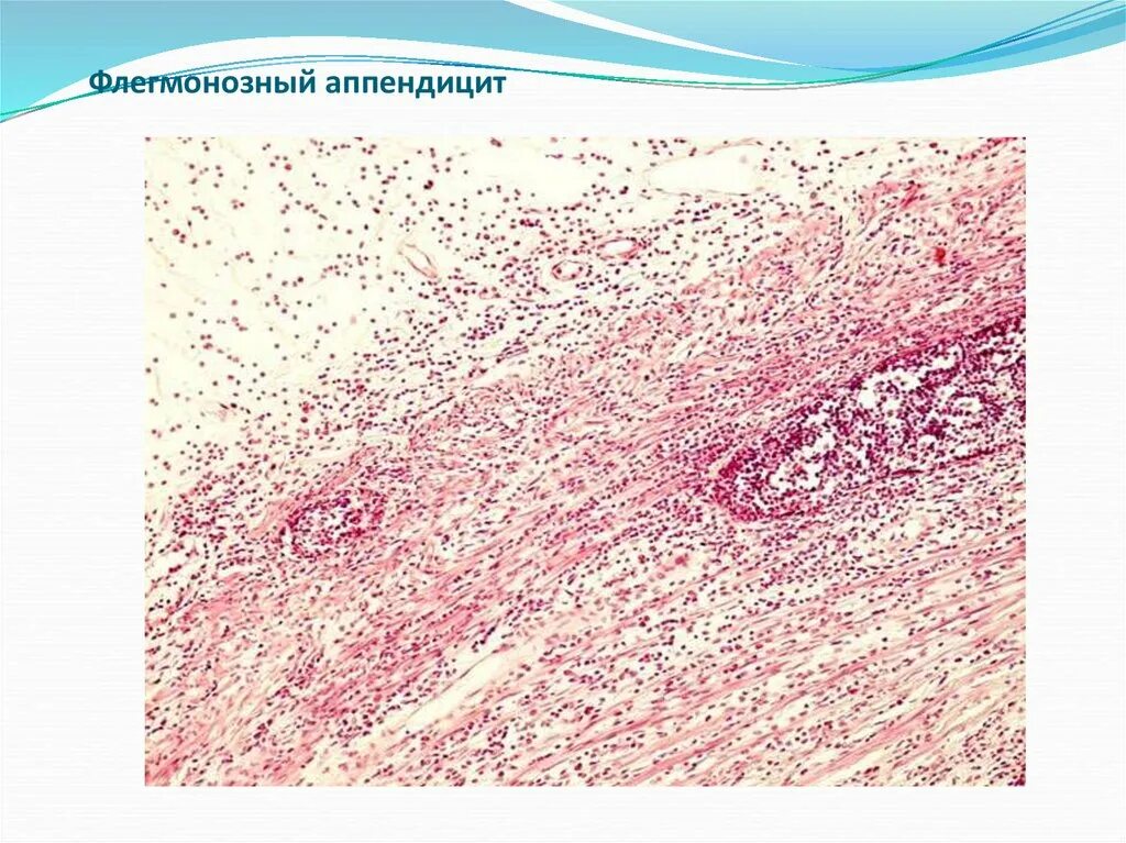 Флегмонозный холецистит гистология. Флегмонозный аппендикс. Флегмонозный аппендицит микропрепарат. Флегмонозный холецистит микропрепарат.