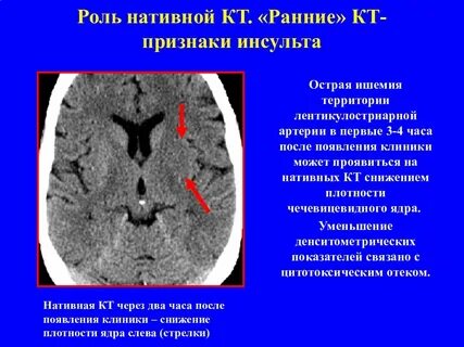 Острый ишемический инсульт