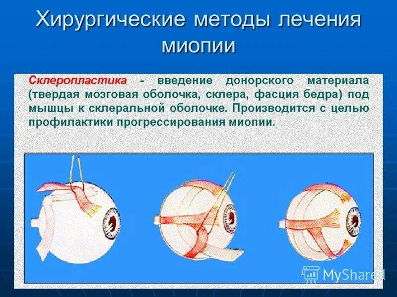 Вылечит ли близорукость операция. Склеропластика схема операции. Склеропластика при миопии. Склеропластика при близорукости.