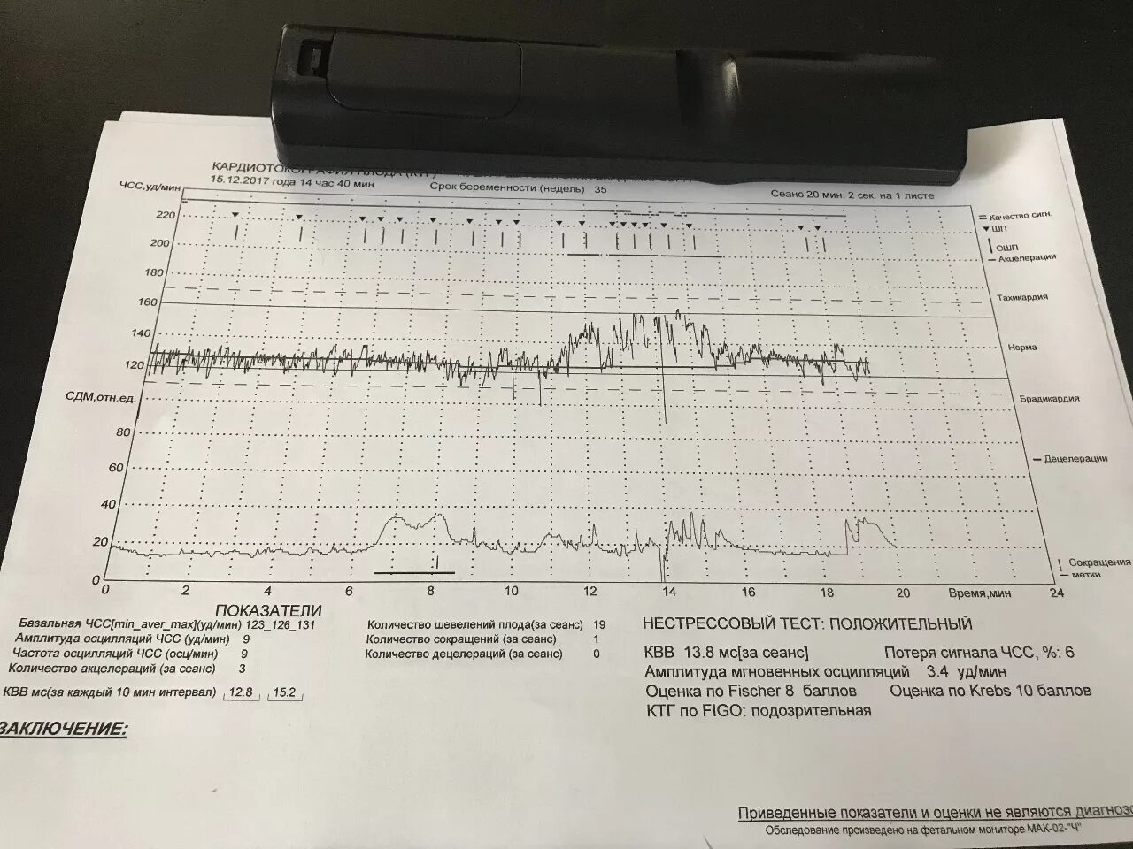 Исследование сердцебиения плода. Базальный ритм на КТГ. Нормальная диаграмма КТГ. КТГ расшифровка показателей. Показатели КТГ плода расшифровка.