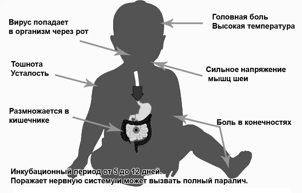 Полиомиелит возбудитель механизм передачи. Полиомиелит пути передачи возбудителя инфекции. Паралитический период полиомиелита. Полиомиелит у детей вакцинация. Полиомиелит прививка заразна