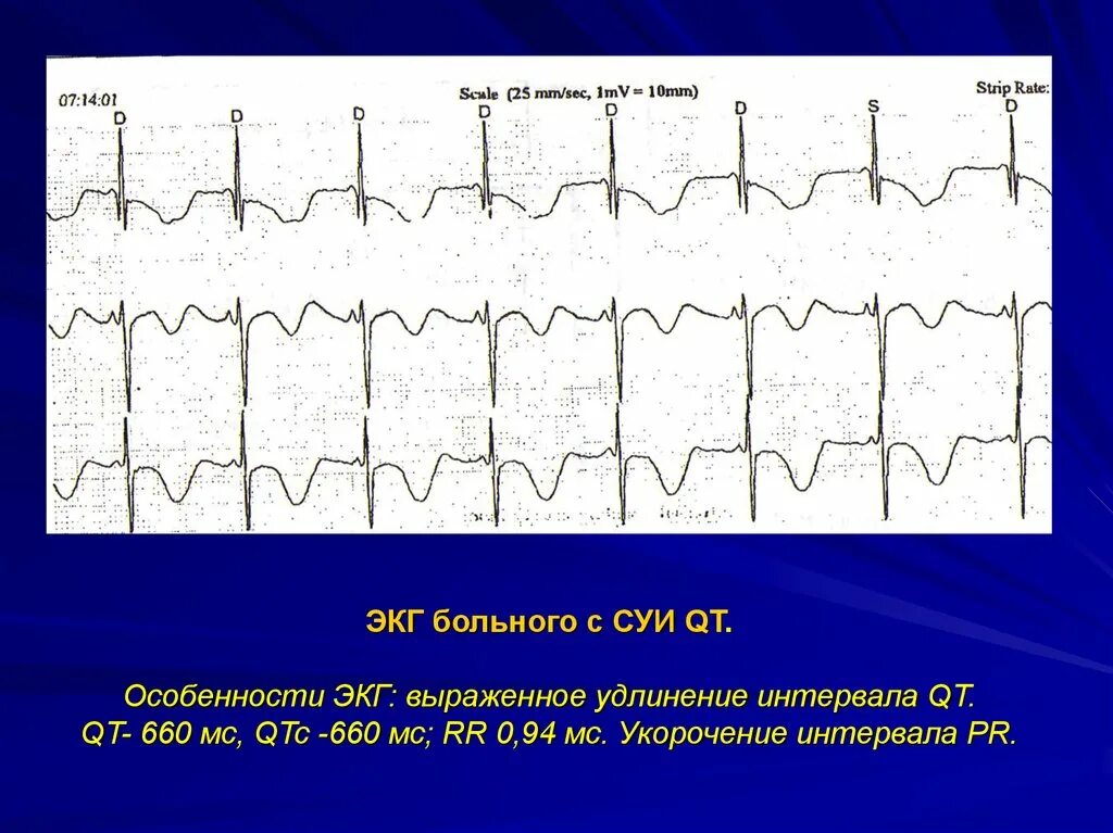 Удлиненное qt на экг. Синдром удлиненного qt на ЭКГ. Синдром удлиненного интервала qt на ЭКГ. Синдром удлиненного qt критерии. Удлинённый интервал qt на ЭКГ.