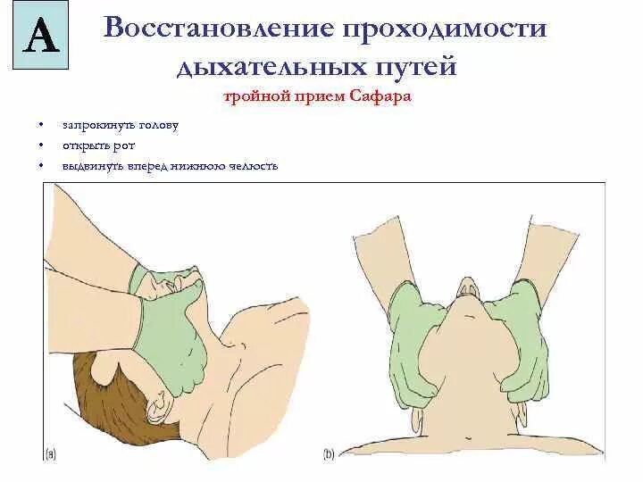 Сердечно легочная реанимация положение головы