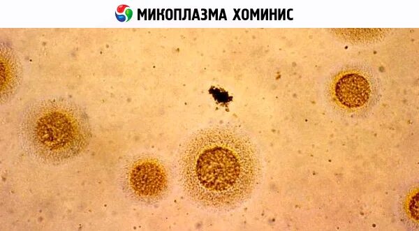 Mycoplasma hominis полукол днк. Микоплазма хоминис 1.00 10 4. микоплазма хоминис у женщин. микоплазма гоминис mycoplasma hominis у женщин.