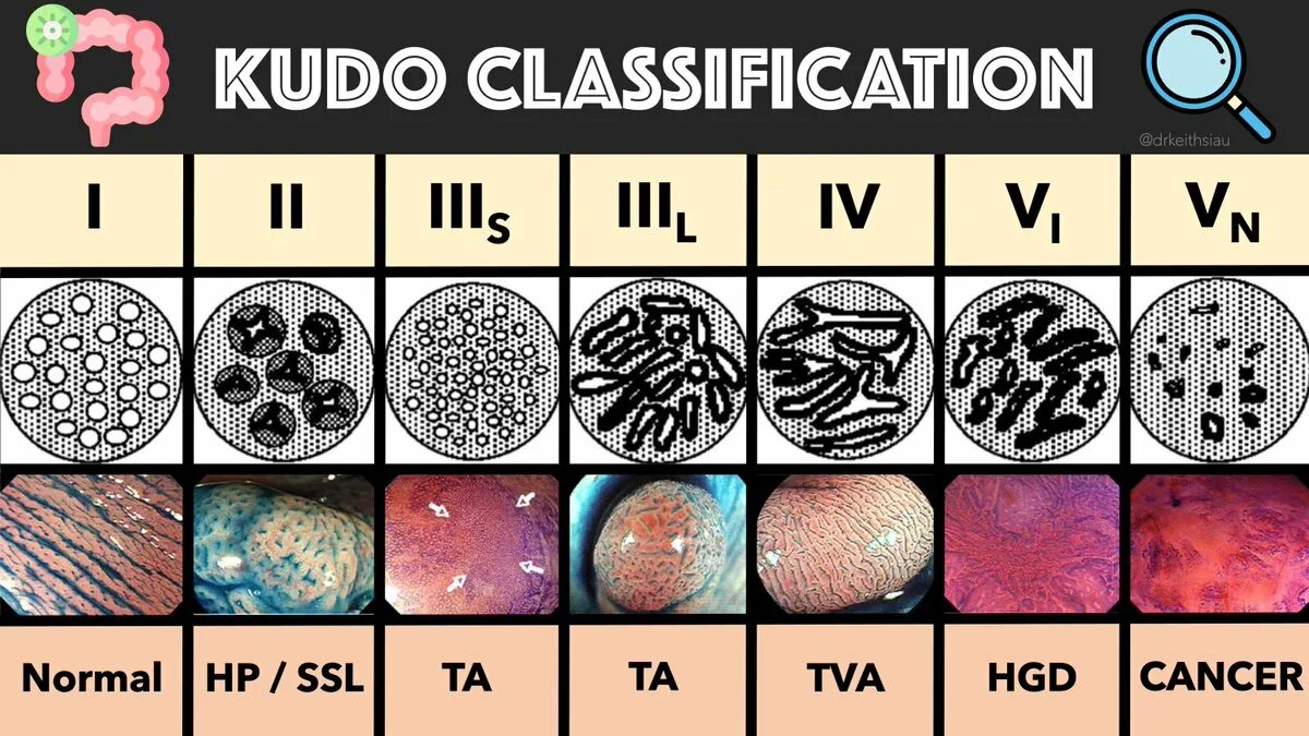 Тип 0 is. Pit pattern классификация Kudo. Классификация по Kudo. Kudo эндоскопия классификация. Kudo классификация полипов.