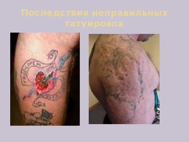 Последствия неправильного выбора. Последствия татуировок. неправильное заживление татуировки. плохие последствия тату.