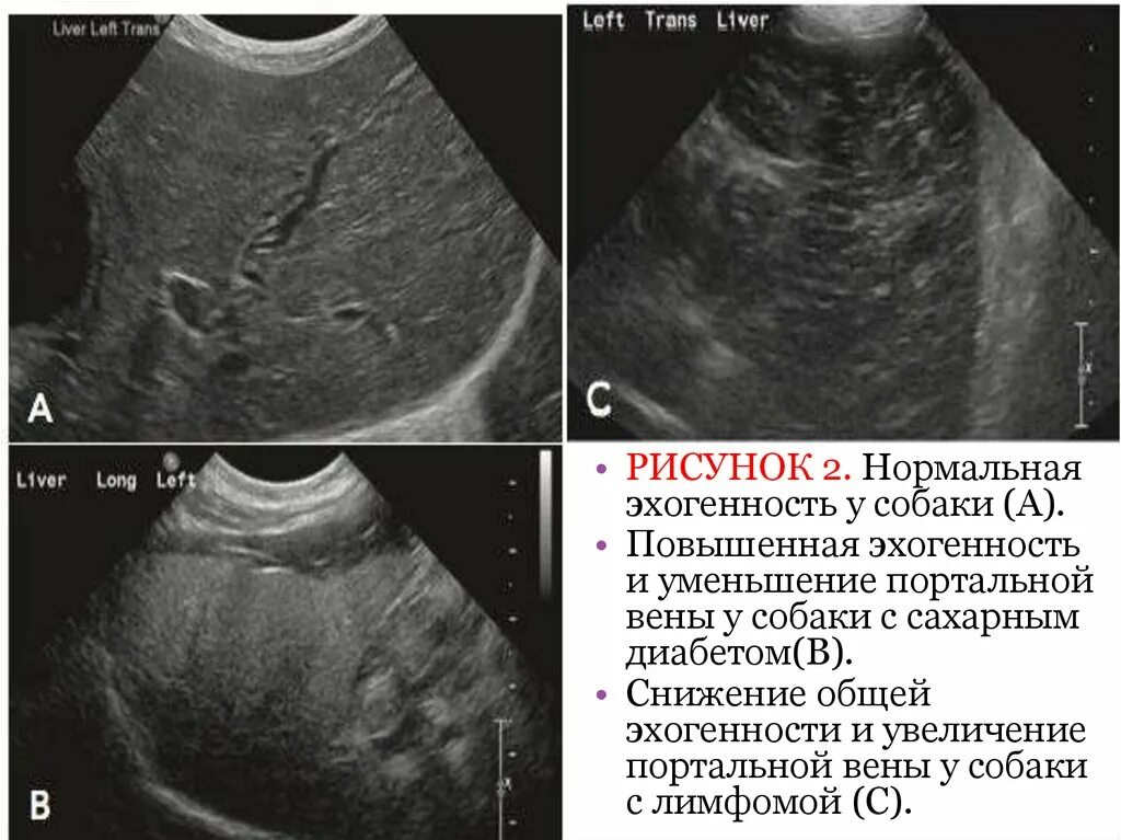 Пониженная эхогенность печени. Повышенной эхогенности. Эхогенность печени. Эхогенность печени понижена.