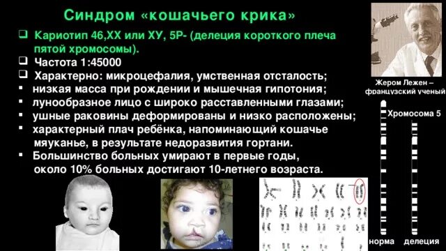 Кариотип больного с синдромом кошачьего крика. Наследственные заболевания человека синдром кошачьего крика. Делеция 5 хромосомы синдром кошачьего крика. Хромосомные мутации кошачий крик.