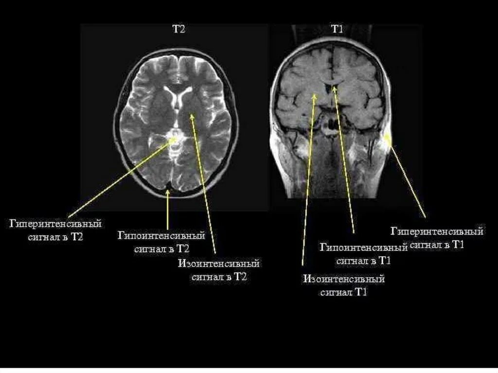 Мрт гипоинтенсивный сигнал т2. Сигналы мрт т1 и т2. Мрт головного мозга т2. Т2 взвешенное изображение мрт. Очаговые изменения желудочка