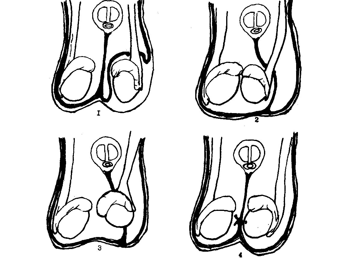 Ножки яички. Операция Шемакера- Петривальского. Крипторхизм эмбриогенез. Надмошоночный крипторхизм.
