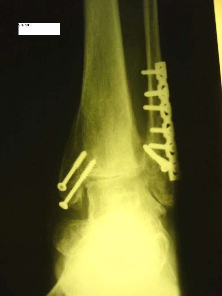артродез подтаранного сустава. операция артродез голеностопного сустава. артродез голеностопного сустава. операция артродез голеностопного сустава. артродез подтаранного сустава.