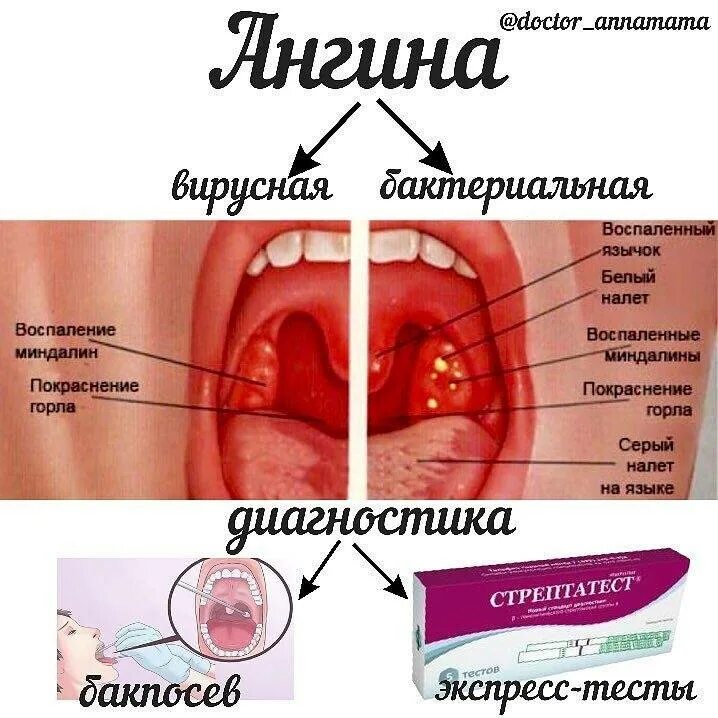 Во рту температура без. Бактериальная фолликулярная ангина. Герпесная ангина и бактериальная. Язвенно-плёнчатая форма тонзиллита.