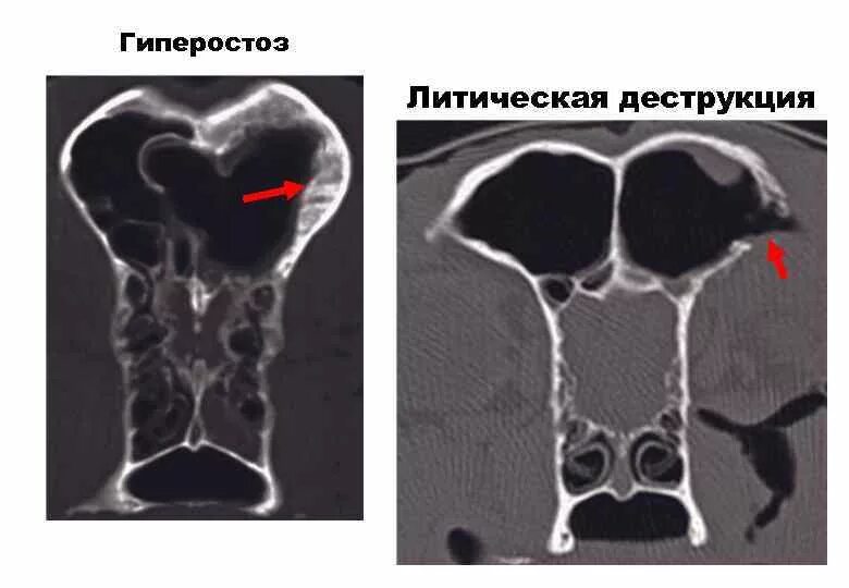 Литическая деструкция что это. Аневризмальная костная киста большеберцовой кости. Литическая деструкция что это. Литическая деструкция что это. Деструкция костей рентген.