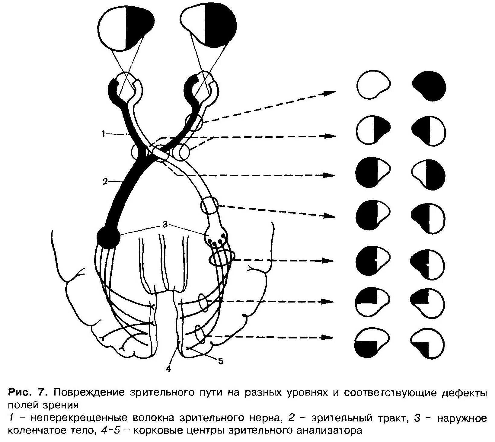 Зрительный нерв неврология схема. Ход волокон зрительного нерва. Поражение зрительного нерва неврология. Зрительный анализатор симптомы поражения на различных уровнях.