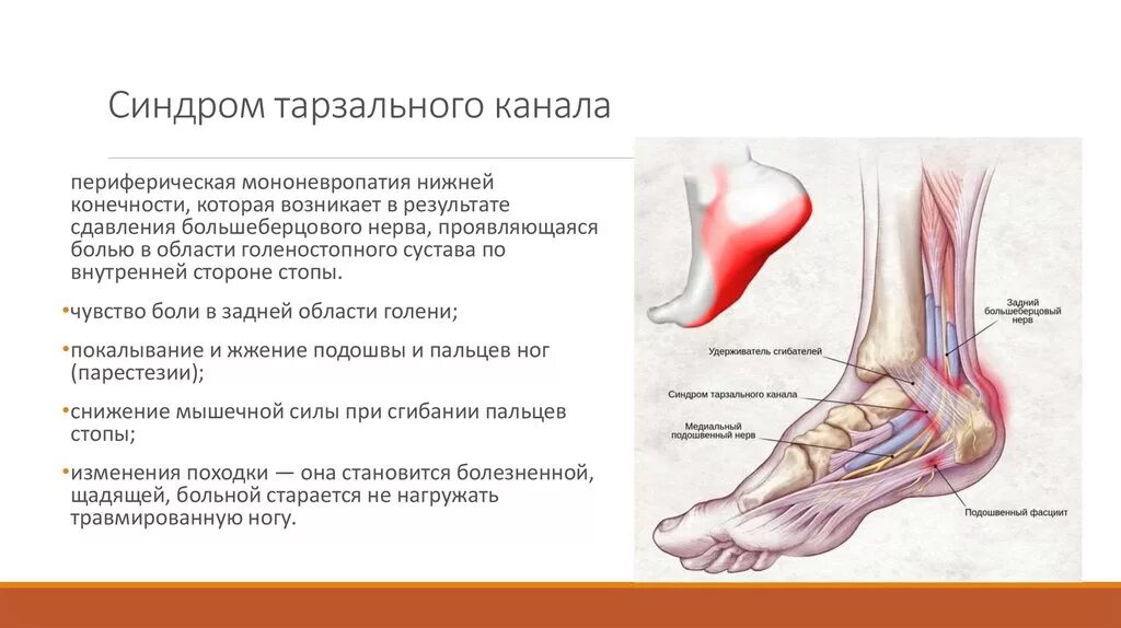 Синдромы голеностопного сустава. Туннельный синдром большеберцового нерва. Синдром тарзального канала большеберцового нерва. Синдром тарзального канала стопы. Синдром тарзального канала нерв.