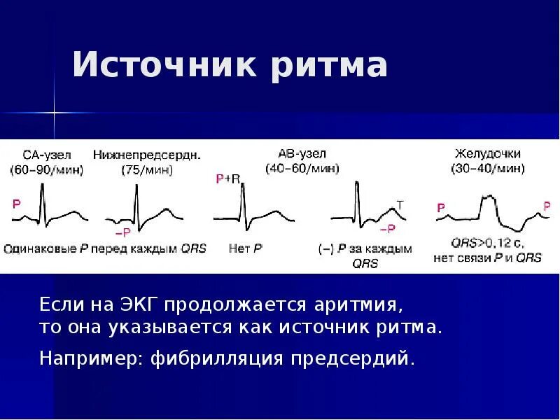 Ускоренный эктопический предсердный ритм. Эктопическая аритмия на ЭКГ. Эктопический предсердный ритм у ребенка. Предсердный ритм на ЭКГ. Эктопический предсердный ритм что это