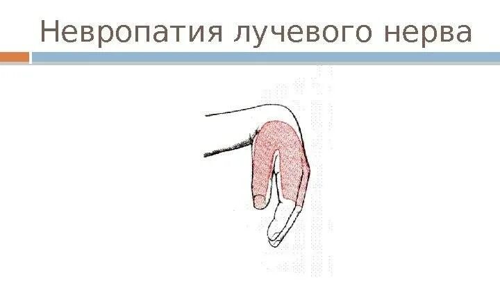 Невропатия локтевого нерва мкб. Клиника нейропатии лучевого нерва. Неврит лучевого нерва клиника. Клинические проявления невропатии лучевого нерва. Нейропатия лучевого нерва нерва.