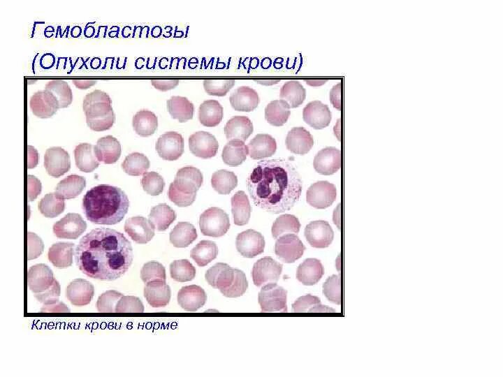 Опухоли системы крови (гемобластозы).. Гемобластозы — заболевания кроветворной ткани:. Опухоли системы крови гемобластозы патанатомия. Гемобластоз картина крови. Опухоль клеток крови