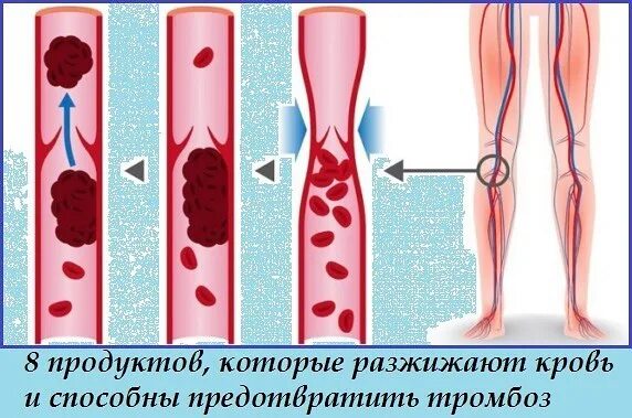 Профилактика тромбов в сосудах. Профилактика тромба в организме человека. Как предотвратить тромбоз. Как избежать тромбов в сосудах. Тромбоз фильтры