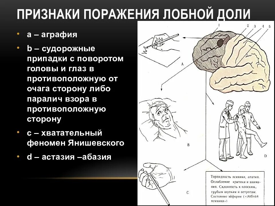 Поражения корково мозга. Синдром поражения лобной доли неврология. Повреждение лобной доли симптомы. Синдром поражения лобной доли головного мозга. Симптомы поражения лобной доли головного мозга неврология.