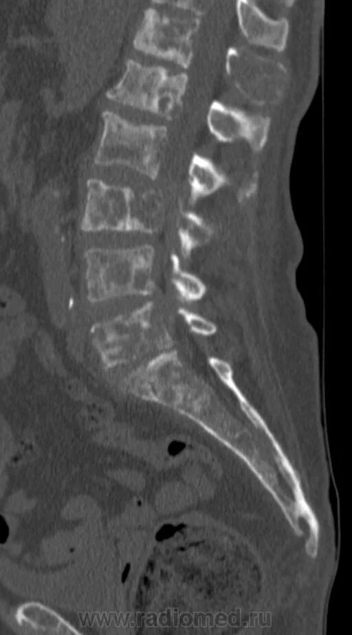 Рак поясницы. Остеобластические метастазы мрт. Остеосклеротическая миелома. Остеосаркома позвонка рентген. Остеопороз позвонков на кт.