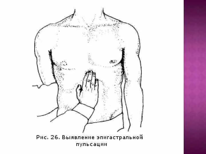 Почему сильно пульсирует в животе. Пальпация эпигастральной пульсации. Патологическая эпигастральная пульсация. Эпигастральная пульсация у детей. Эпигастральная пульсация пальпируется.