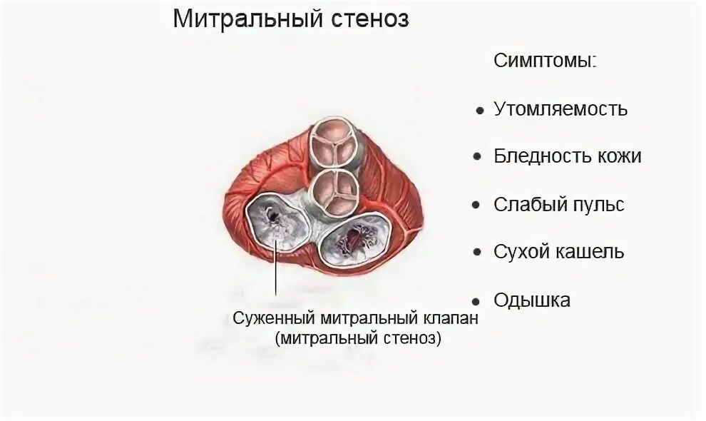 Митральный стеноз признаки. Бессимптомный митральный стеноз. Стеноз митрального клапана симптомы. Проявления стеноза митрального клапана. Митральный стеноз симптомы.