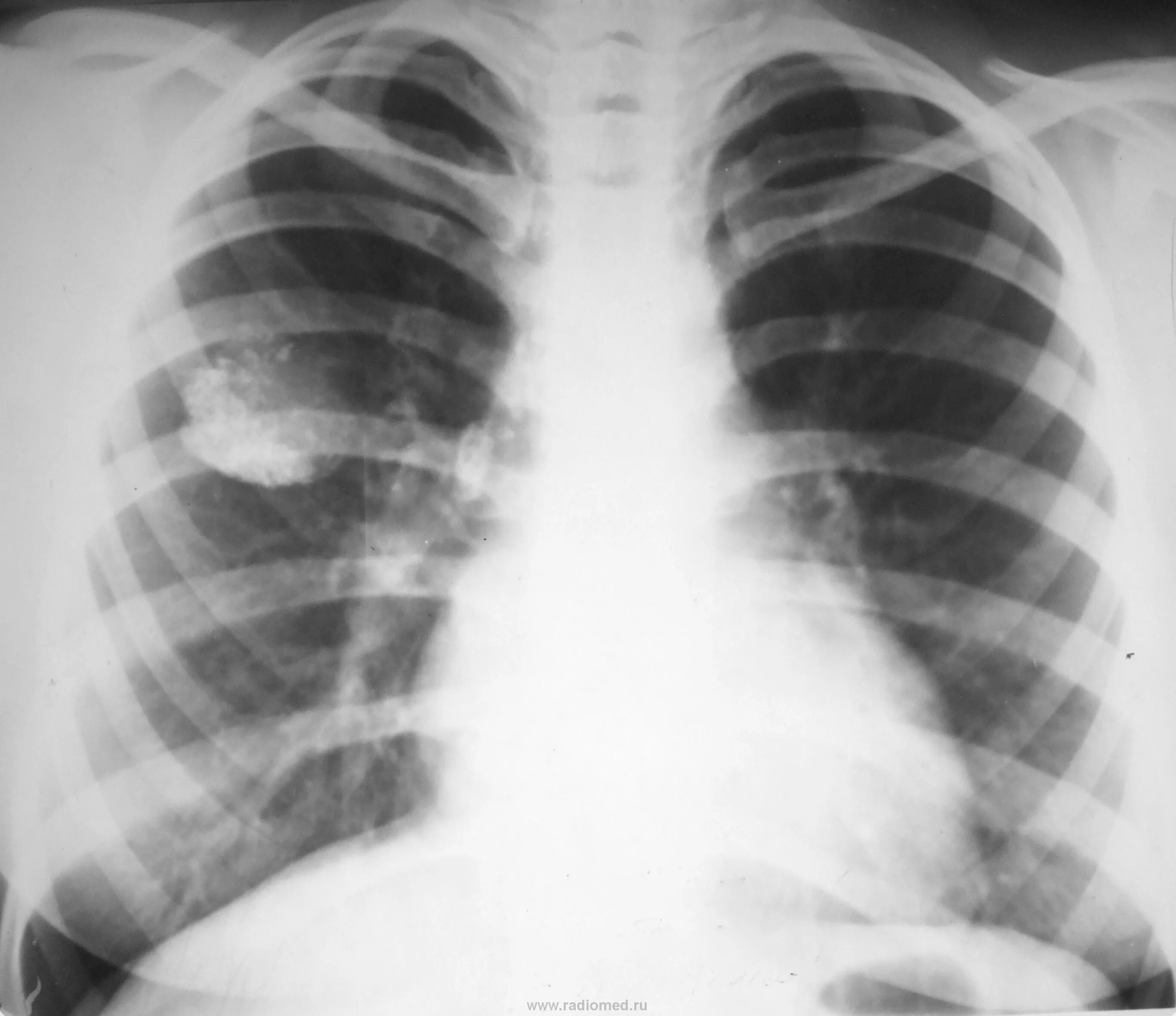Туберкулез молочной. ПТК на рентгенограмме. Первичный туберкулезный комплекс в фазе кальцинации.