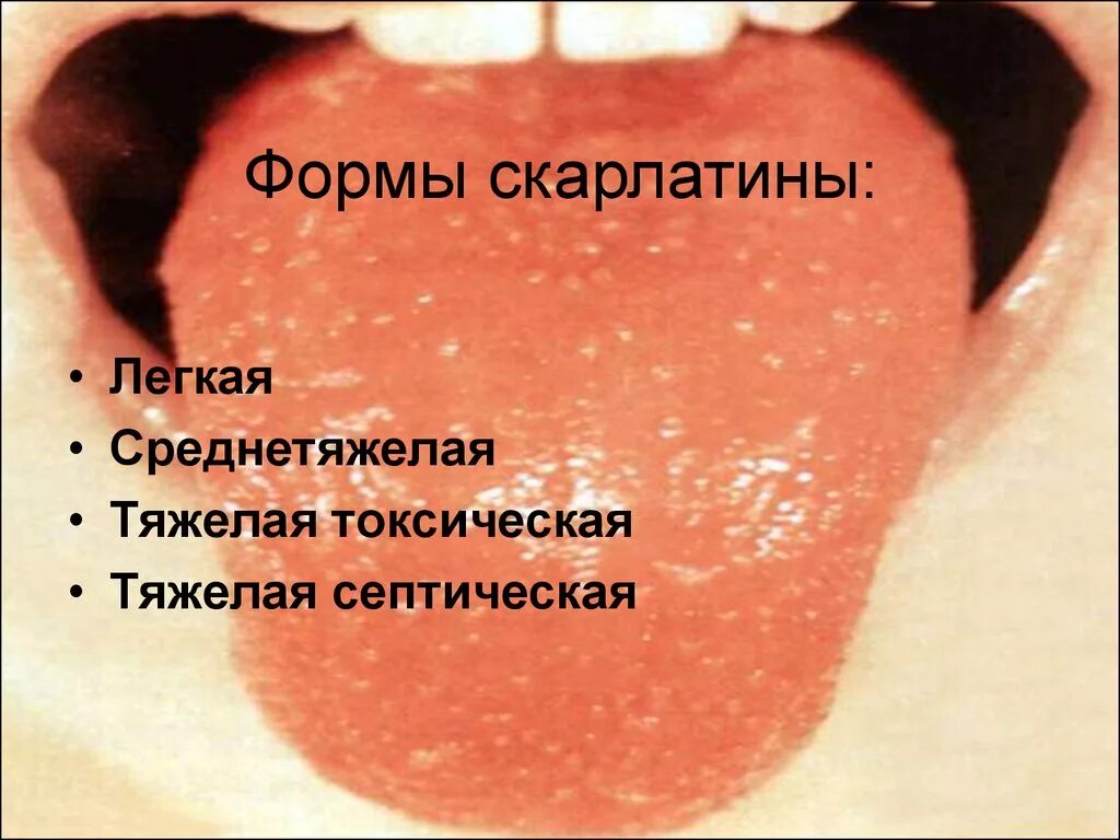 у ребенка температура болит язык