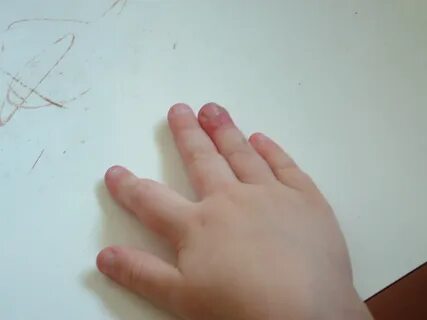 Болит палец у ребенка