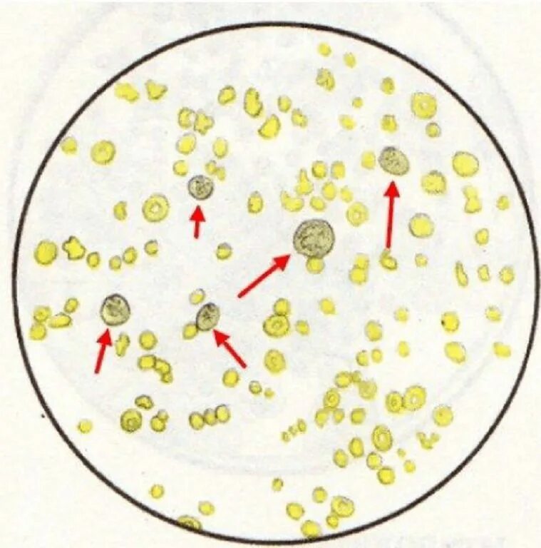 Распад мочи. Лейкоциты в моче микроскопия. Эритроциты в моче микроскопия. Лейкоциты при микроскопия мочи. Почечный эпителий и лейкоциты в моче.