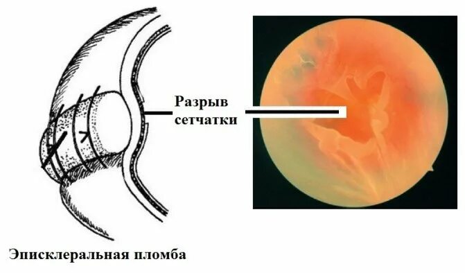 Решетчатая дистрофия сетчатки глаза. Периферический разрыв сетчатки. Повреждение сетчатки