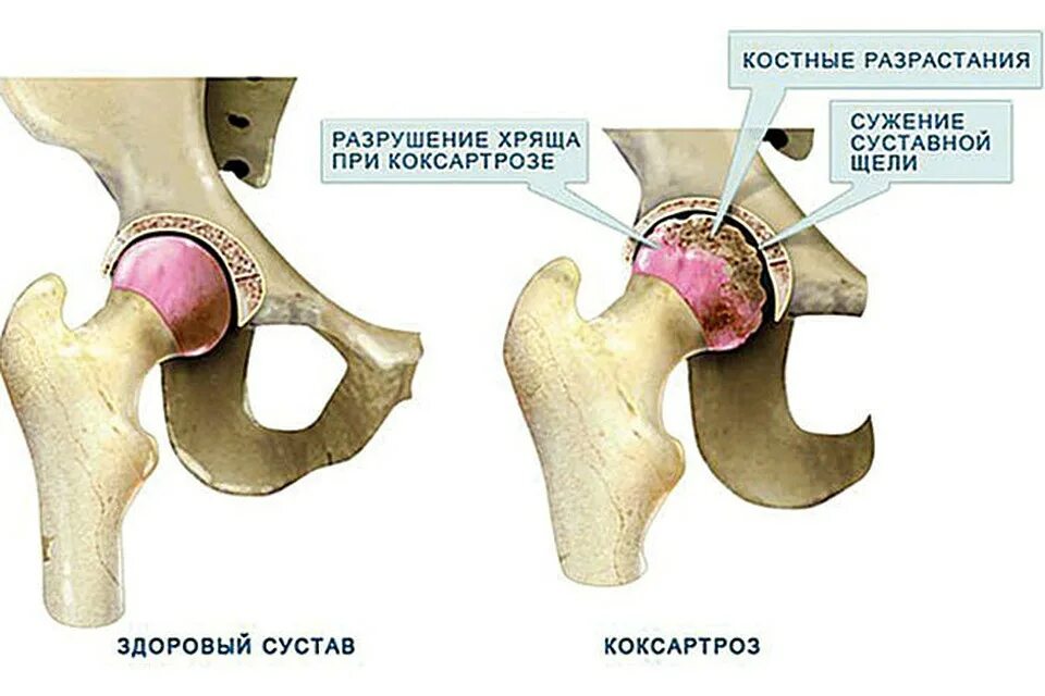 Коксартроз тазобедренного 1 степени у женщин лечение. Двусторонний коксартроз тазобедренного сустава 1-2. Коксартроз тазобедренного сустава 2 стадии. Рентген коксартроза тазобедренного сустава 3 степени. Коксартроз эндопротезирование тазобедренного сустава.