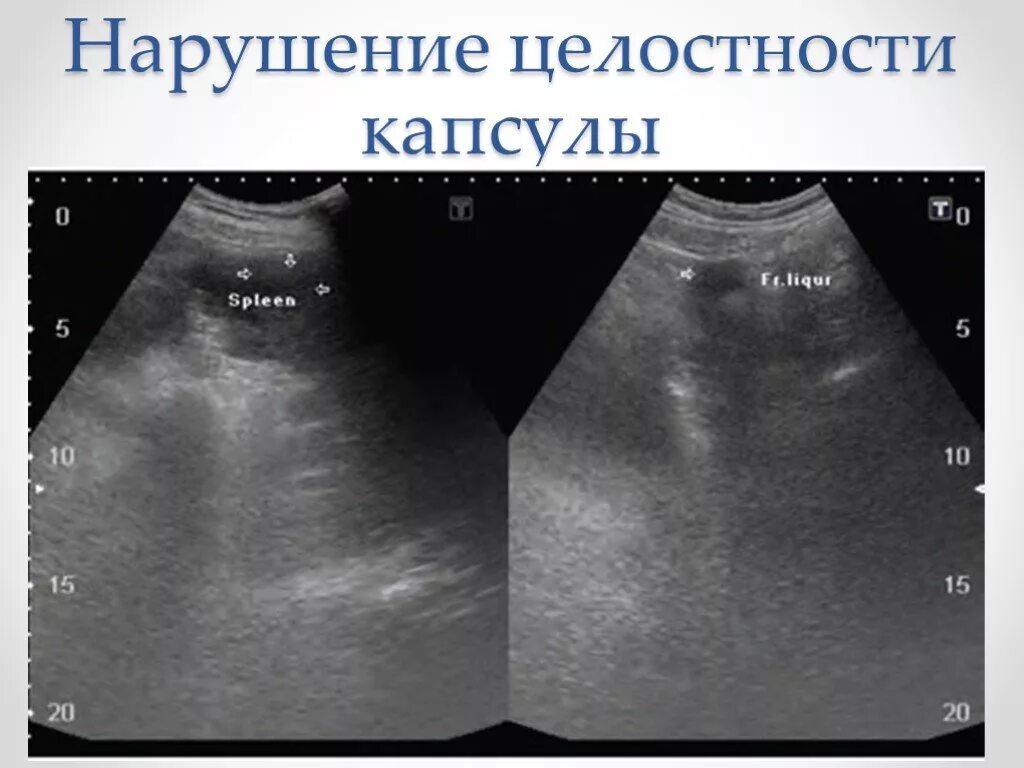 Операции на селезенке. Разрыв селезенки УЗИ признаки. УЗИ селезенки при травме.