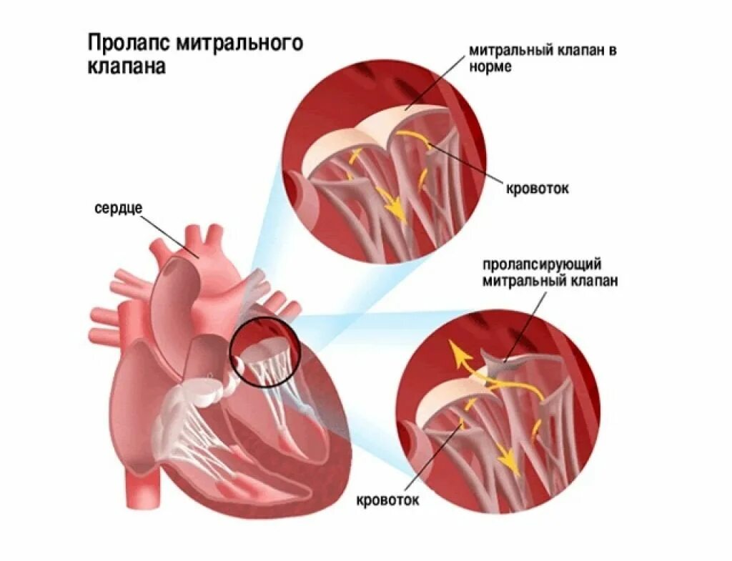Пмк 1 степени что это такое