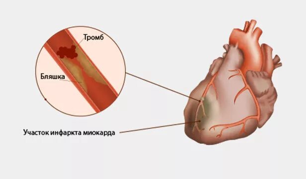 Инфаркт миокарда тромбоз. Тромб в желудочке