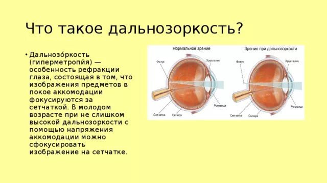 Чем дальнозоркие близорукие глаза отличаются от нормальных