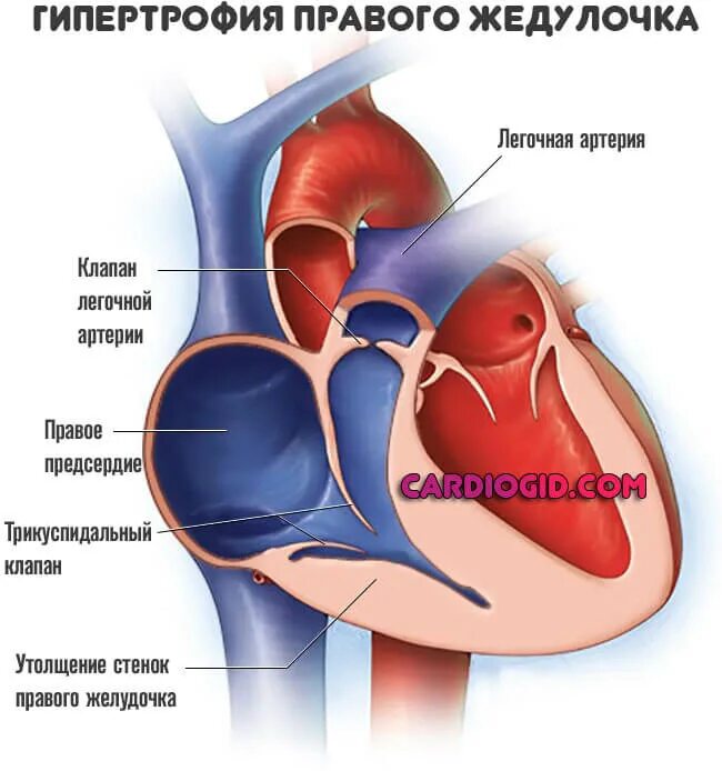 Стеноз клапана легочного ствола. Изолированный клапанный стеноз легочной артерии. Легочная артерия клапан норма у новорожденных. Предклапанным стенозом легочной артерии. Сужение устья легочной артерии.