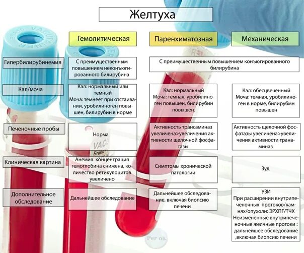 Моча при анемии. Цвет мочи при желтухе. механическая желтуха моча. механическая желтуха цвет мочи. темная моча при желтухе.