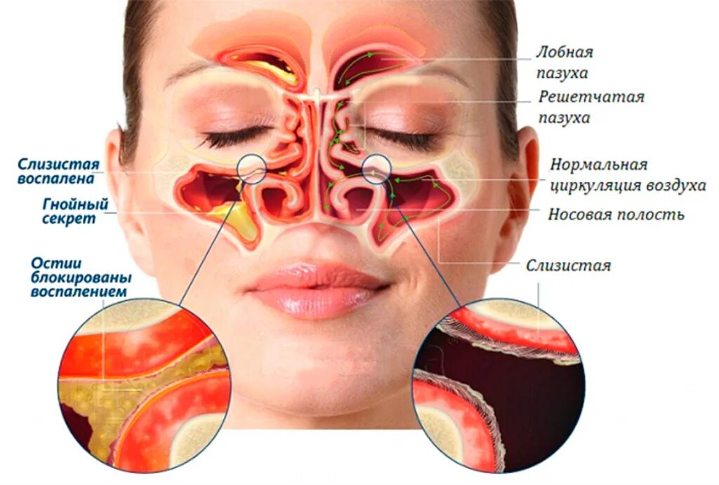 Болит переносица при нажатии насморка. Гайморовы пазухи гайморит. Носовая пазуха и гайморова пазуха. Носовые пазухи строение гайморит.
