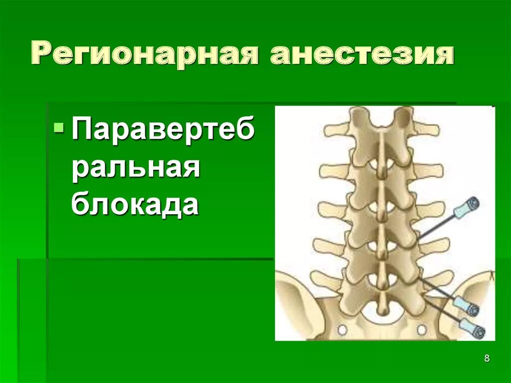 Паравертебральная поясничная блокада. Паравертебральная блокада. Блокада корешковая паравертебральная. Паравертебральная блокада пояснично-крестцовый отдел. Паравертебральная блокада грудного отдела позвоночника.