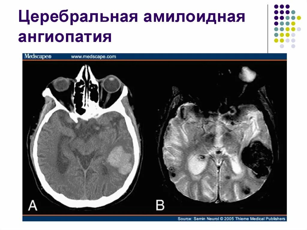 Ангиопатия сосудов головного. Церебральная микроангиопатия кт. Церебральный амилоидоз. Церебральная амилоидная ангиопатия мрт. Амилоидоз головного мозга кт.