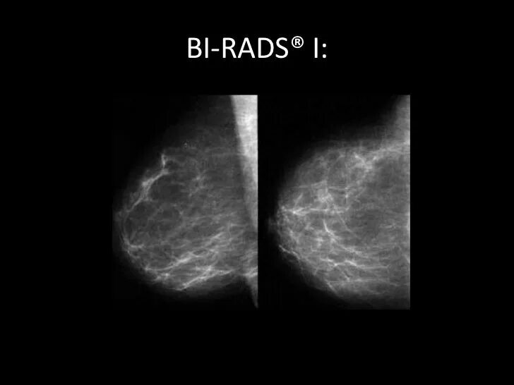 Кисты bi rads 2. Фиброзно кистозная мастопатия молочной железы bi-rads-4a. Маммография bi-rads 4 Тип 4. Маммография шкала bi-rads. Категория bi-rads 1.