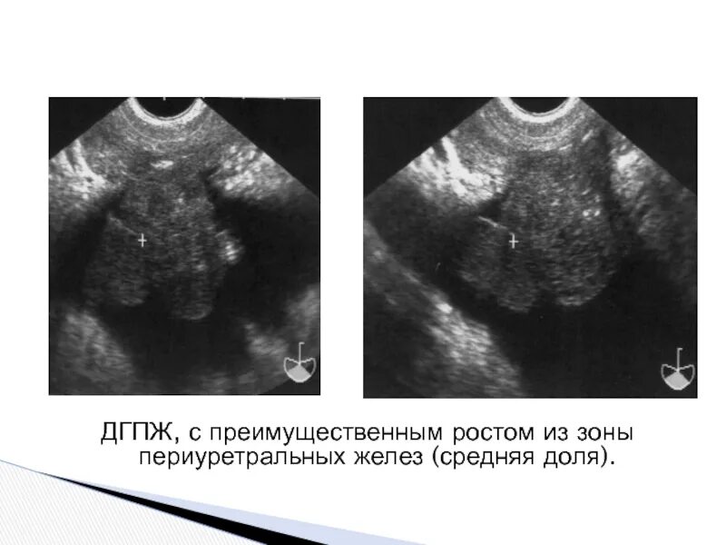 Дгпж узи. Гиперплазия предстательной железы УЗИ. ДГПЖ С внутрипузырным ростом. Гиперплазия средней доли предстательной железы на УЗИ.