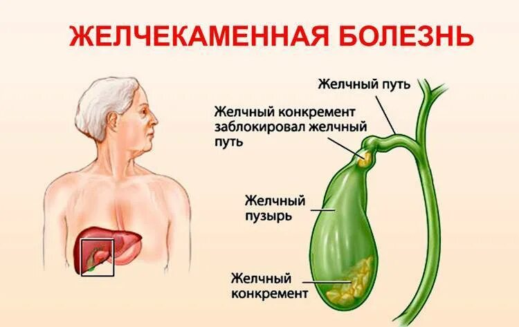 Заболеваний желчевыводящих. Заболевания желчевыводящих путей. Заболевания желчных путей. Инфекции желчного пузыря и желчевыводящих путей. Заболевания желчного пузыр.