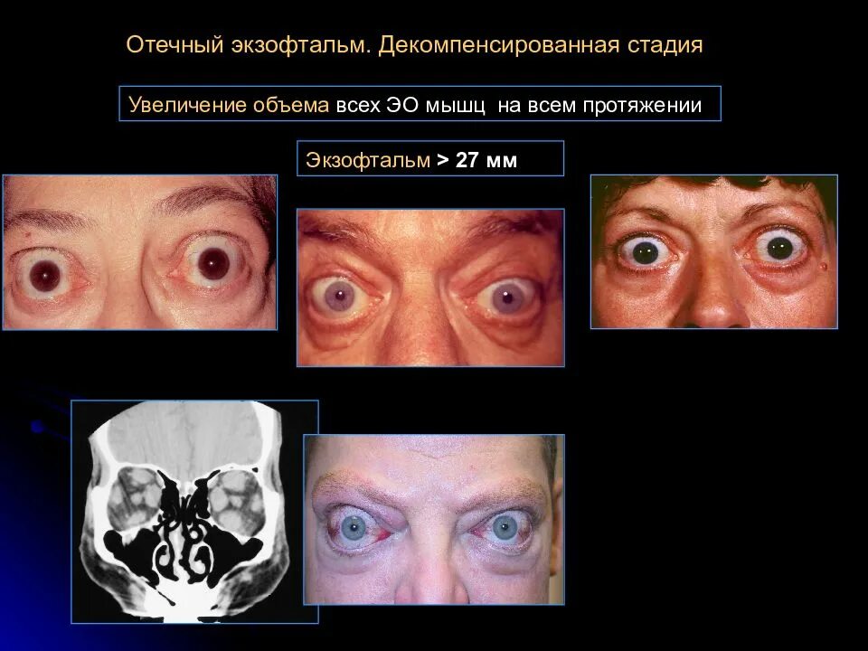 Экзофтальм наблюдается при. Декомпенсированный отёчный экзофтальм. Отечный экзофтальм стадии. Отечный экзофтальм компенсированная стадия. Экзофтальм отек ретробульбарной клетчатки.