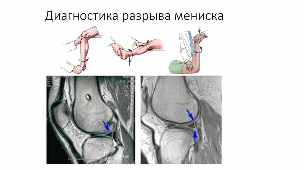 Периферический разрыв мениска. Разрыв мениска коленного сустава рентген. Диагностика разрыва мениска.