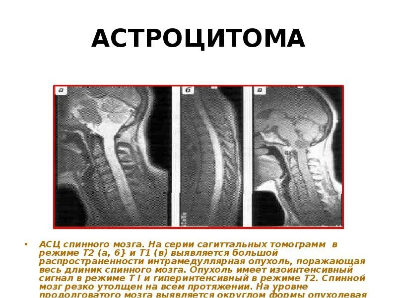 Интрамедуллярные опухоли спинного мозга. Астроцитома спинного мозга мрт. Интрамедуллярная опухоль спинного мозга шейного отдела позвоночника. Интрамедуллярная опухоль спинного мозга мрт. Интрамедуллярные опухоли спинного